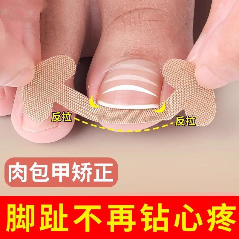Cross-Border Shipping of Ingrown Toenail Correction Device, Specialized Adhesive Patch for Ingrown Nails, Isolation of Toenails That Have Grown into the Flesh of the Foot