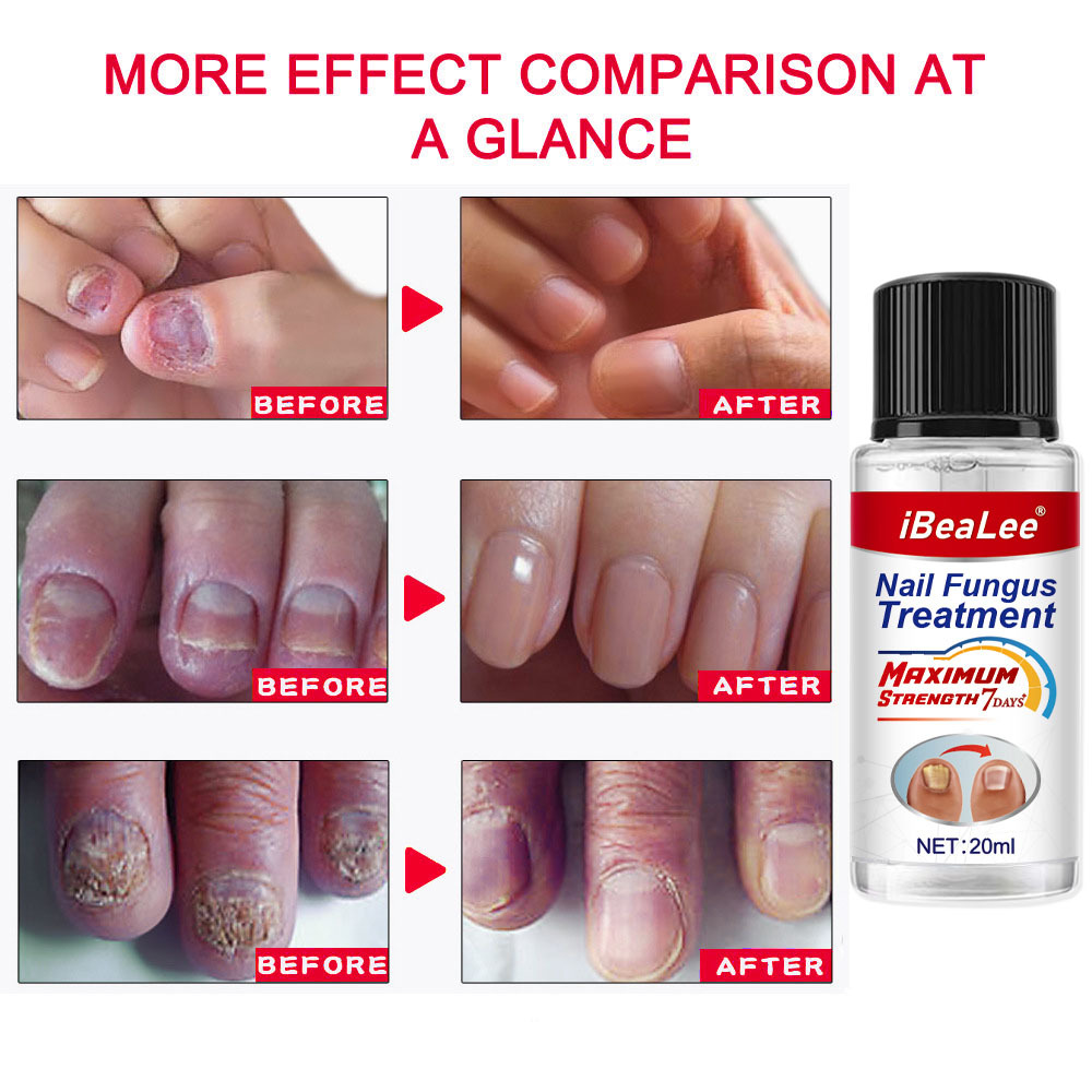 Líquido antibacteriano Crema de eliminación IBeaLee Poción especial espesante para uñas grises suaves_voghion.com