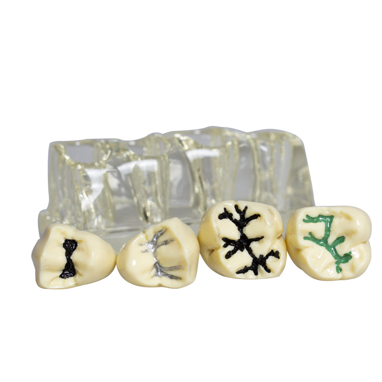 Modelo de cierre de fosas y fisuras dentales para niños contra la caries y la caries Modelo de cierre de fosas y fisuras Modelo transparente