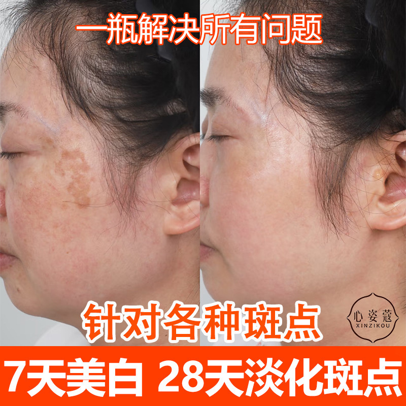 Whitening and Freckle Removal Cream, Powerful Anti-Yellowing and Melanin Removal Cream, Chloasma, Age Spots, Sun Spots, Freckles, Color Control and Freckle Removal Essence Cream