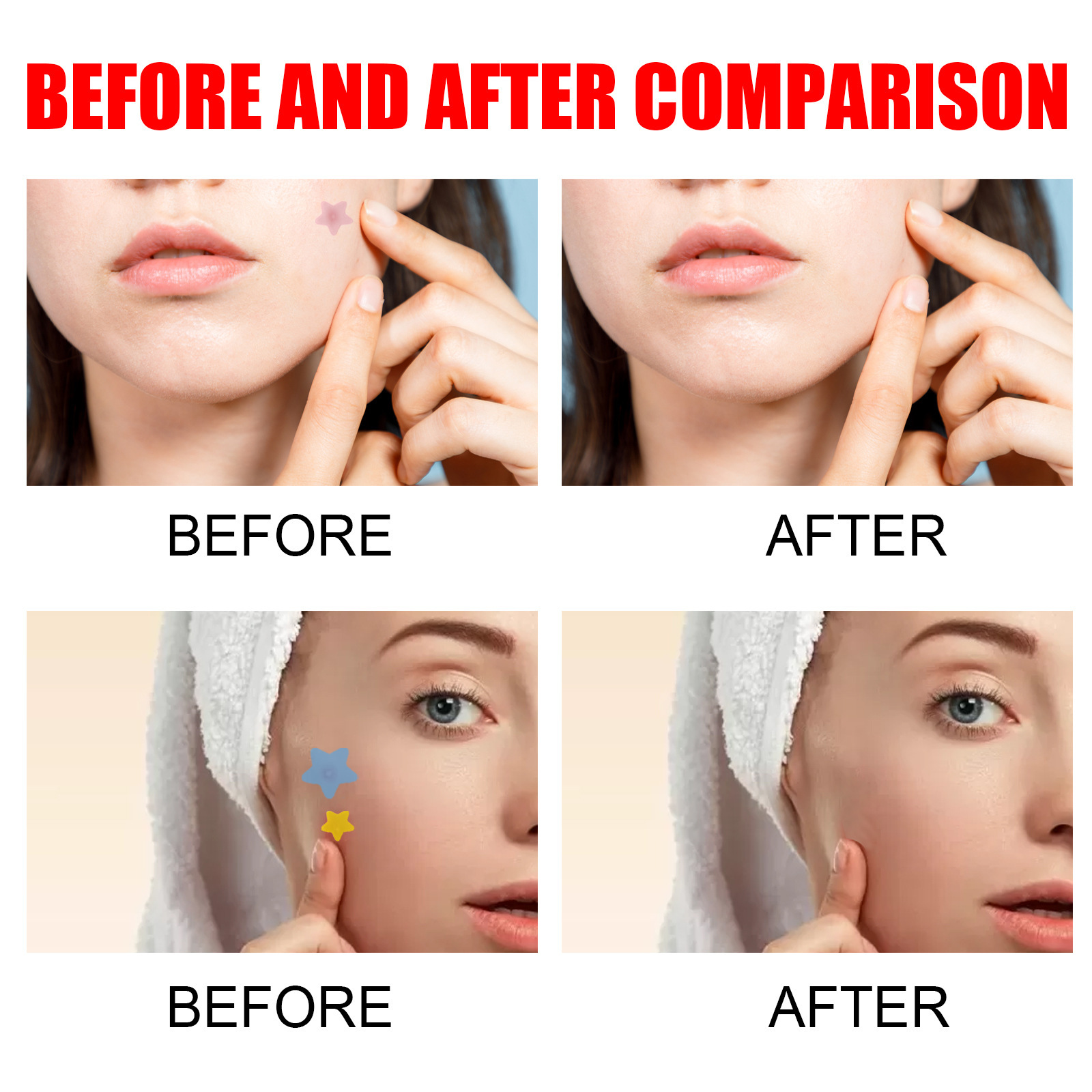 Jaysuing patch to lighten marks, closed mouth blemishes, cover and acne repair patches_voghion.com