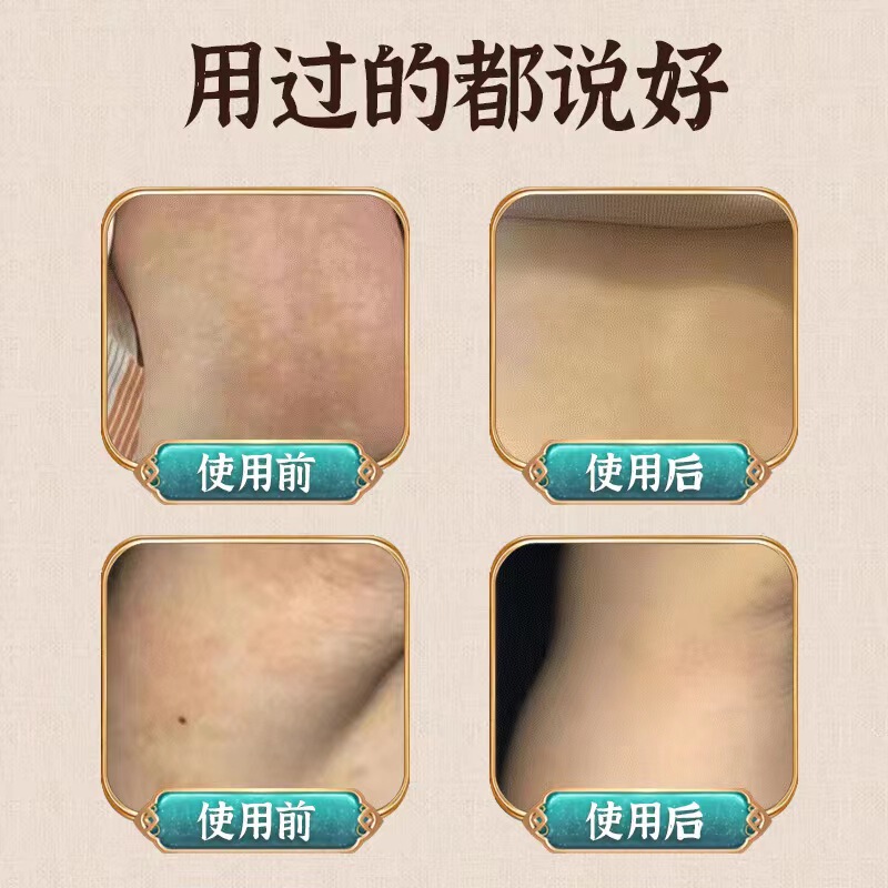 雲南本草白斑純白班白癲癇クリーム皮膚外用クリーム補骨脂メーカー直供代件|undefined