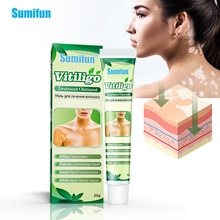Sumifun 速卖通 白斑膏 汗斑花斑身体护理保健膏 皮肤外用K10020