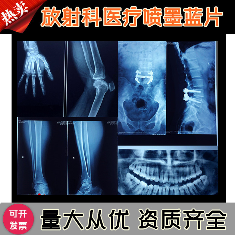 Inkjet blue medical film Blue Base dry radiology printing film dental fracture X-ray film DR CR CT Inkjet blue medical film Blue Base dry radiology printing film dental fracture X-ray film DR CR CT