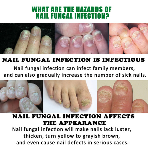 Jaysuing Ginger Nail Care Solution Hand and Foot Nail Care Onychomycosis Repair Soft Nail Brightening Moisturizing Solution