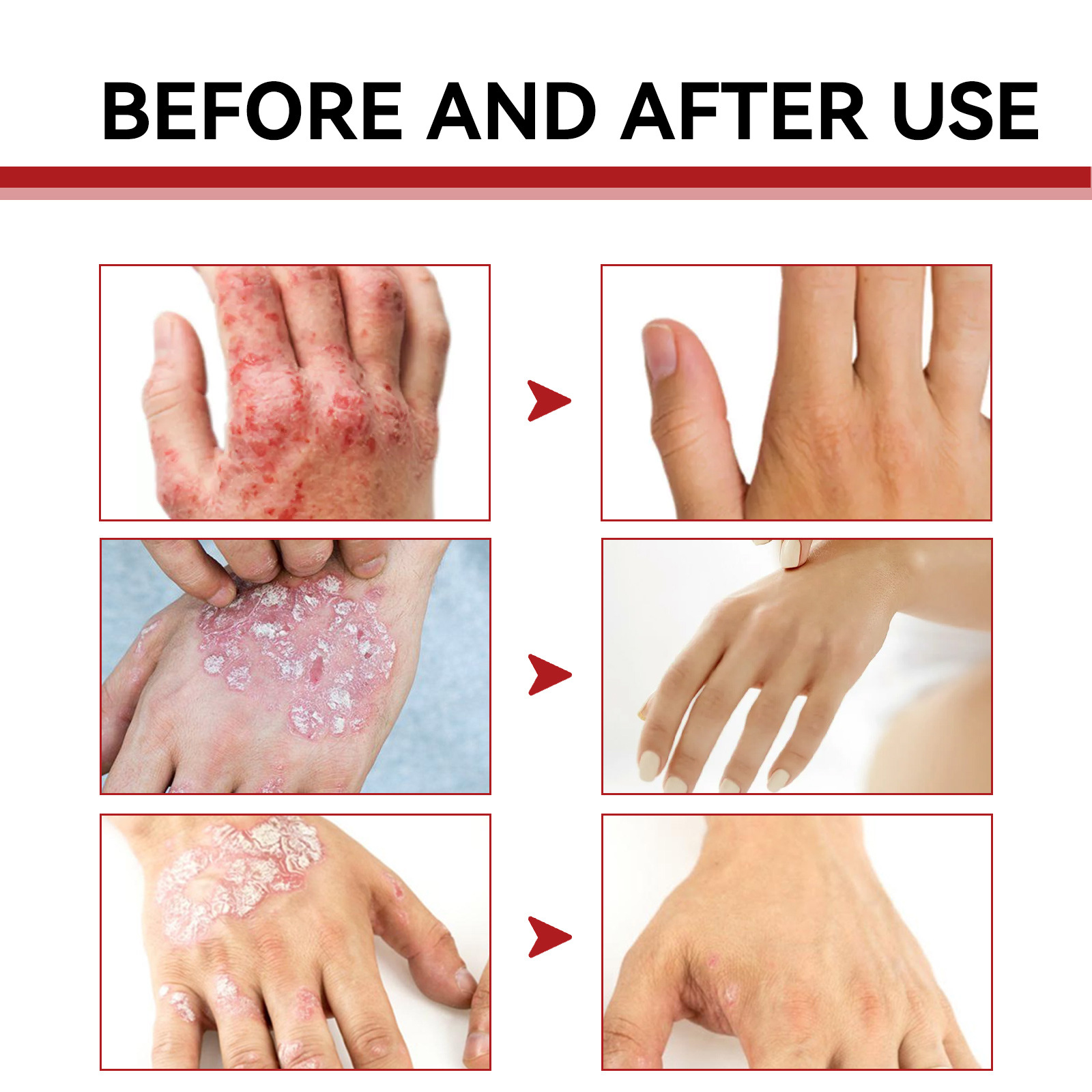 South Moon Psoriasis Care Cream Zarudnutí pokožky těla, svědění, krém proti svědění a lupénce na rukou a nohou_voghion.com