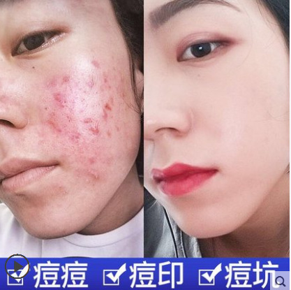 herbal brightening acne cream from black spots for men and women