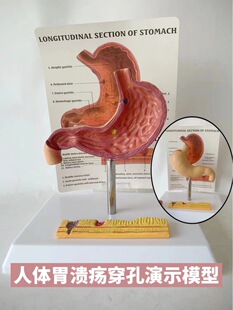 Human gastric anatomy model gastric lesion model gastric disease demonstration model pathological gastric perforation