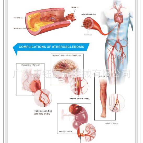 Arteriosklerosis 22