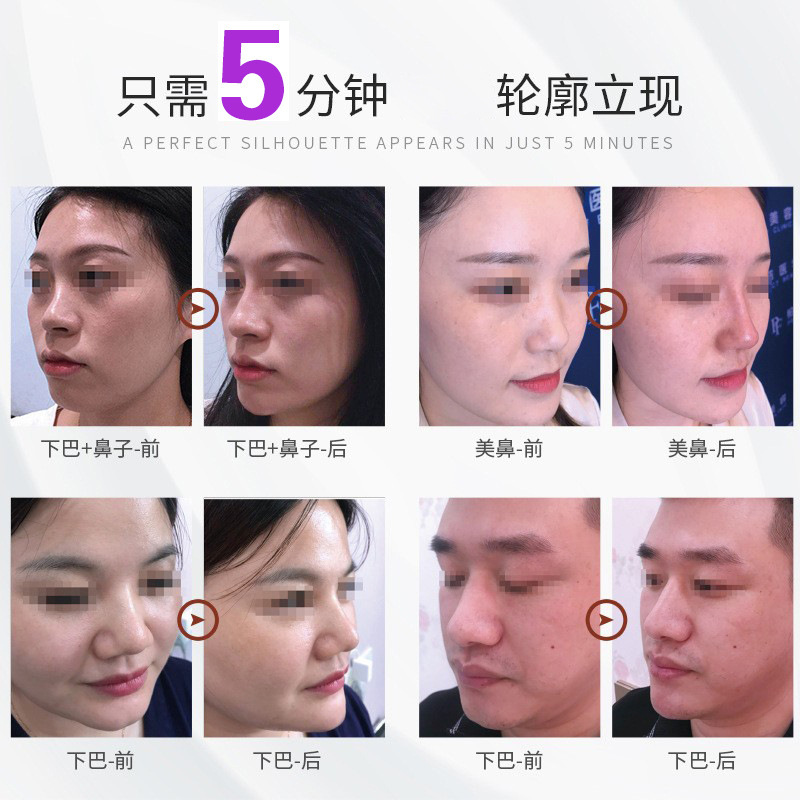 院線乳白骨性材料骨彫刻鼻根あご眉骨鼻基礎輪郭固定は元のメーカーに反落しません。|undefined