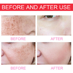 EELHOE Dark Spot Lightening Essence Cream: Fades skin spots, reduces melanin, hydrates, nourishes, repairs, and brightens the skin.