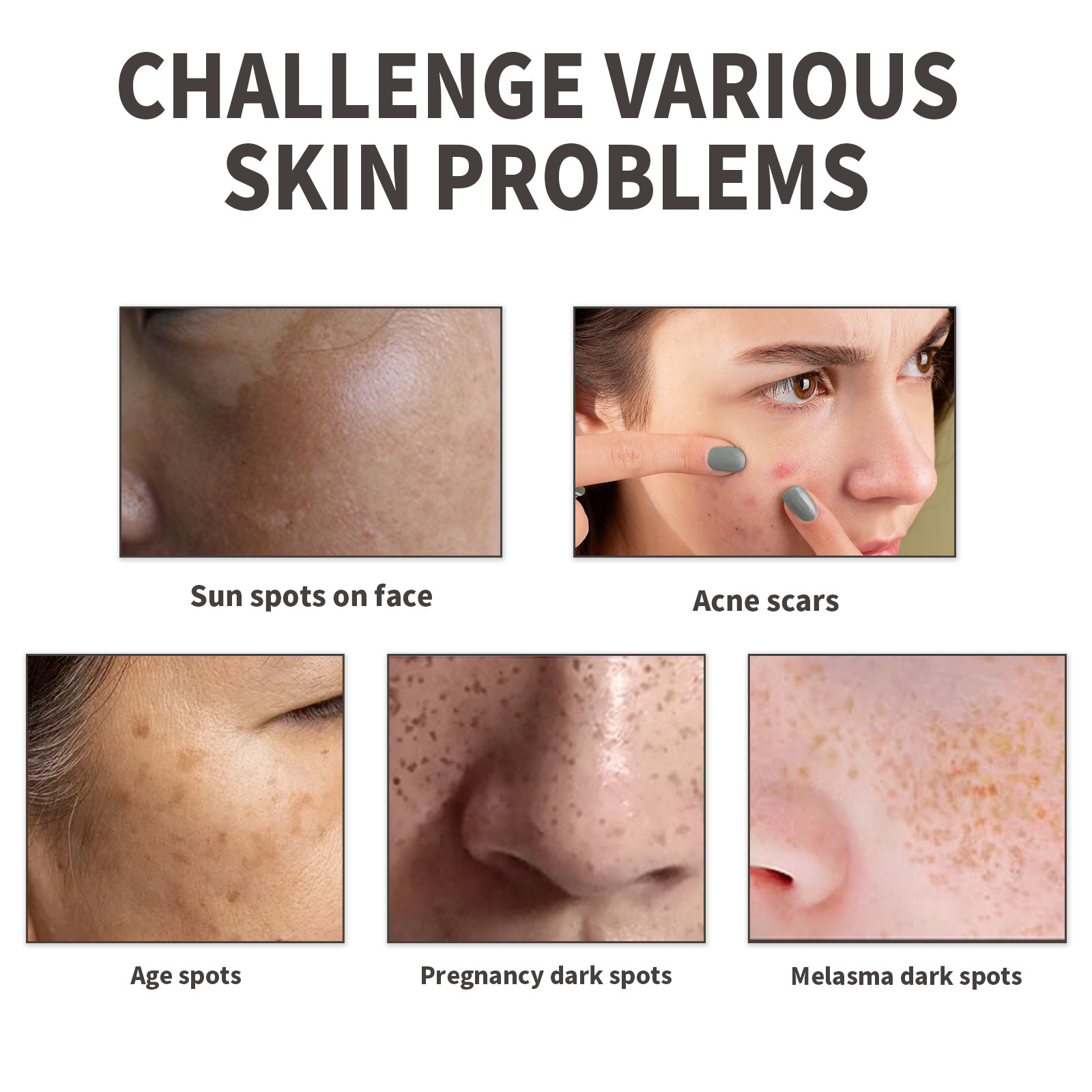 OUHOE Dark Spot&Acne för att bleka fläckar, återfukta huden, reparera aknemärken, mörka och ljusa upp ansiktets essens_voghion.com