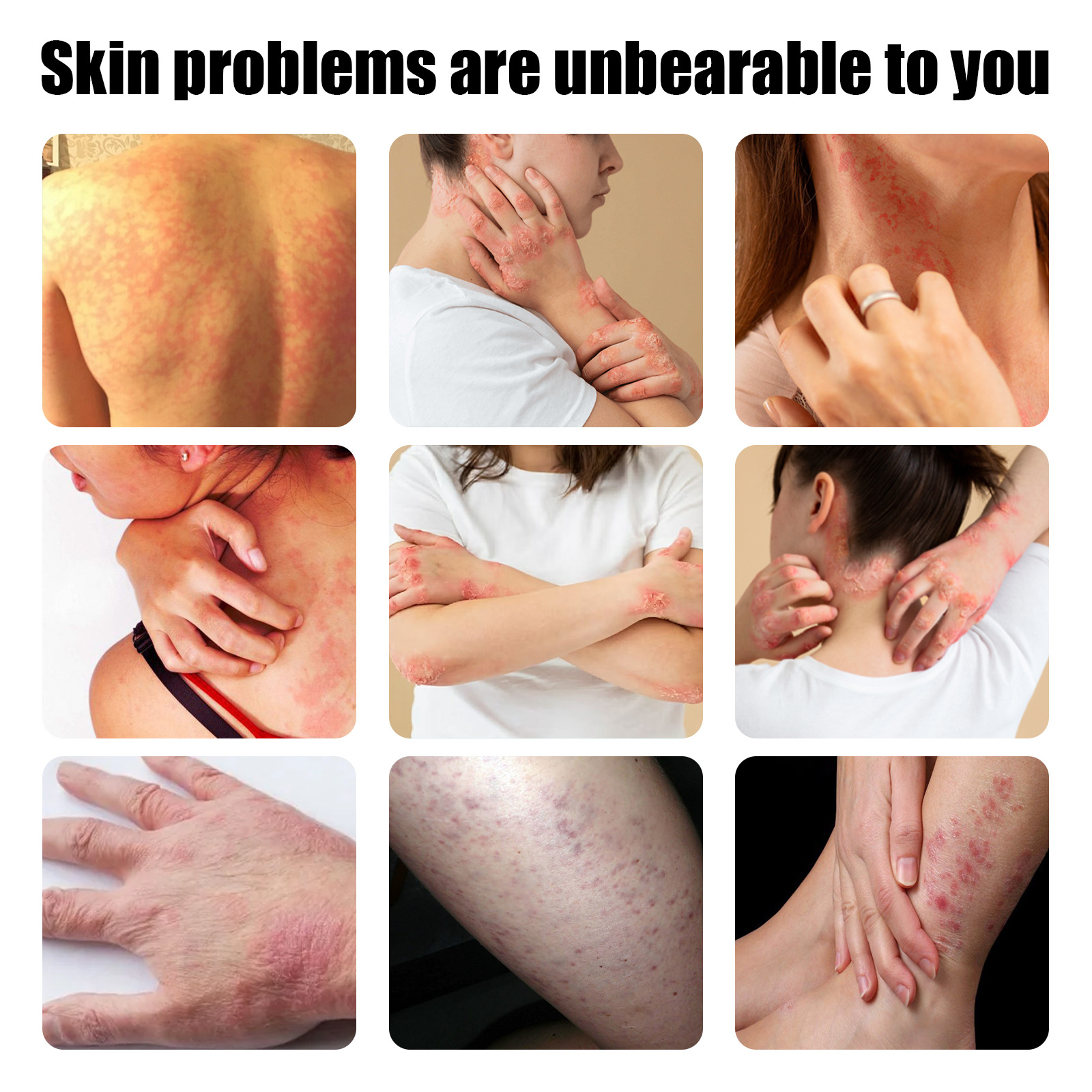 South Moon Skin Care Ointment Relieve Redness and Itching of Hand and Foot Dermatitis Skin Repair Ointment_voghion.com