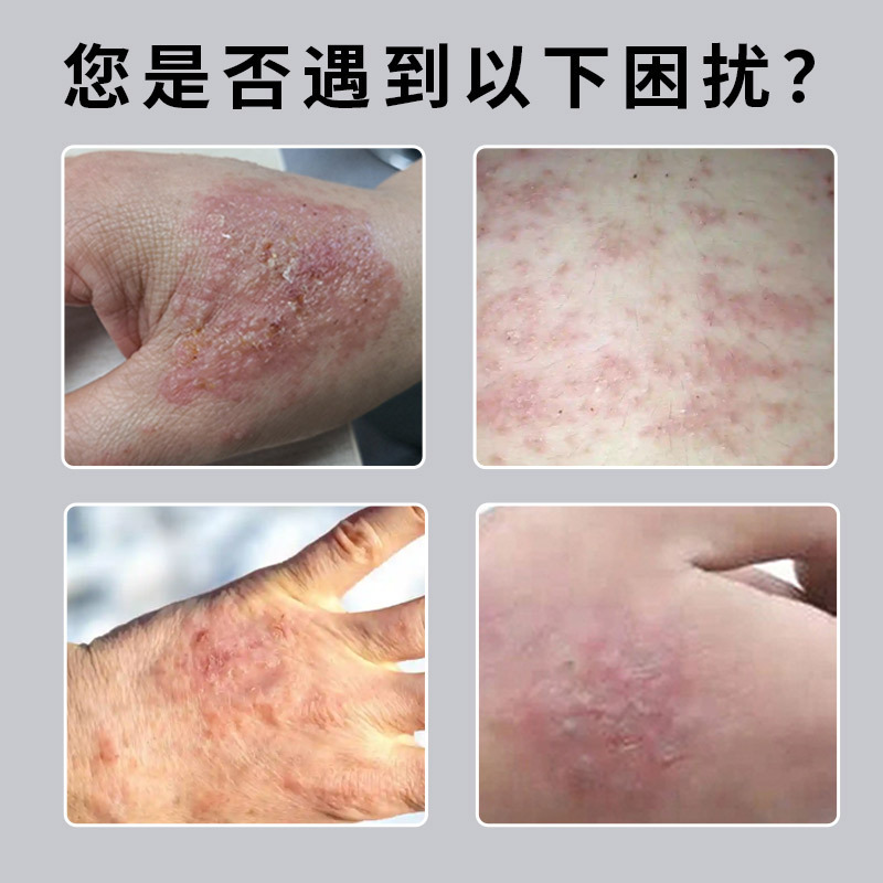 卸売り日本の規格品の頑固性の乾性の皮膚のコケは除湿して根の手のひらの角化の型の専用の膏を取り除きます。|undefined
