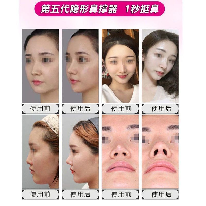 見えない鼻、くしゃくしゃ鼻、美鼻パッド、鼻矯正、鼻翼縮小、鼻クリップ、美鼻、鼻矯正、黒鼻クリップ|undefined