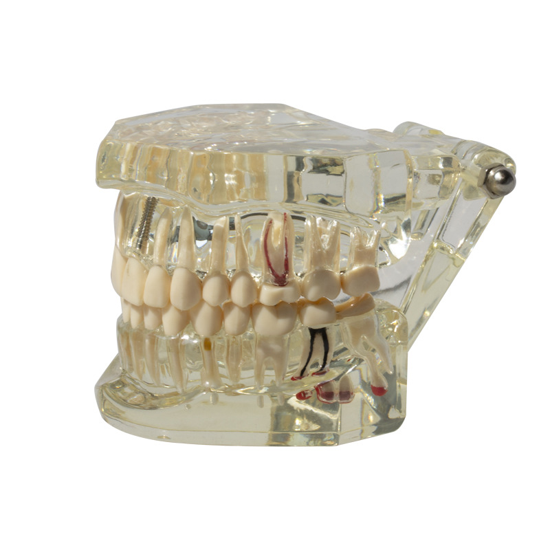 Modelo de implante dental, modelo dental patológico, modelo oral desmontable, modelo de explicación de puente, protección dental