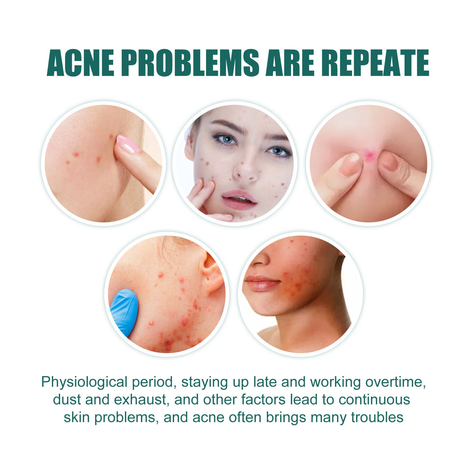 Das sternförmige EELHOE-Pflaster hellt Flecken auf, deckt Narben ab und repariert Akne-Flecken_voghion.com