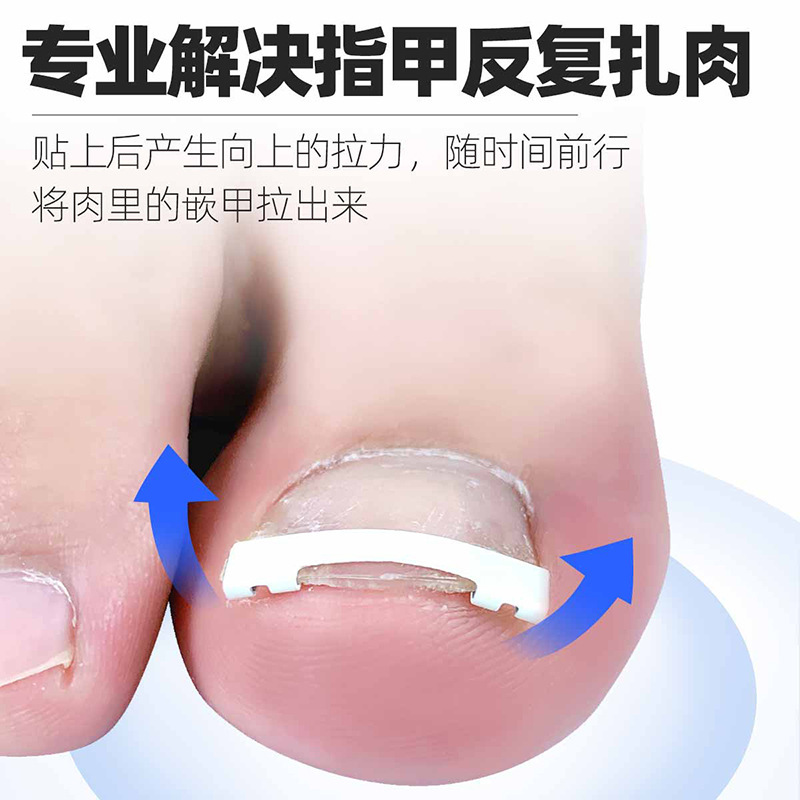 Fizug Ingrown Toenail Nickel-Titanium Alloy Straightening Buckle Corrector for Toenail Groove Correction Tool