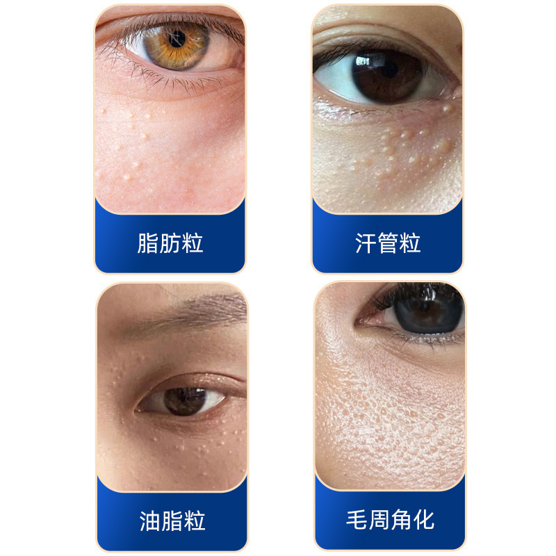 云南本草颗粒清肌膏眼周脂肪粒去除神器草本清肌膏抖音直播同款|undefined
