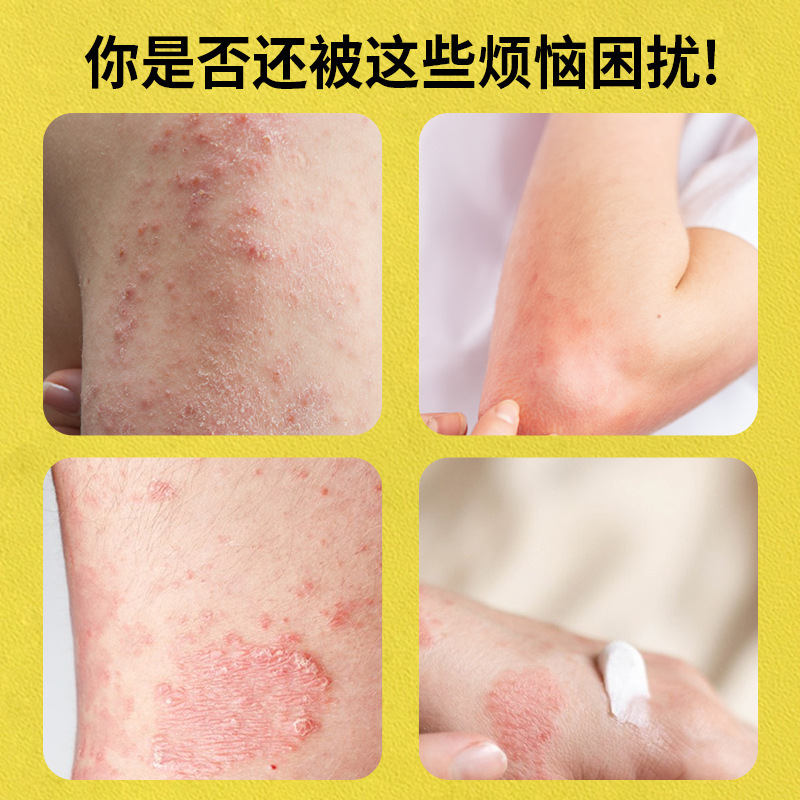 云南本草五毒七草真菌王药膏50g皮肤外用保健乳膏止痒抑菌膏批发|undefined