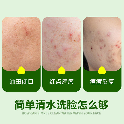 Mugwort anti-itch and mite-removing soap, essential oil soap, wholesale skin itching, sterilization, acne removal, men's and women's cleaning and bathing handmade soap