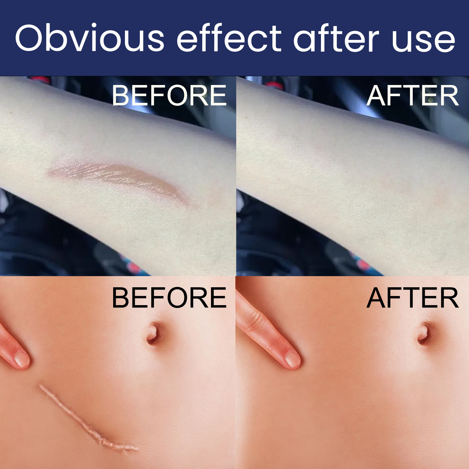 desalinizare reparare intervenție chirurgicală de sarcină cicatrice hiperplazie piele îngrijire arsură gel_voghion.com