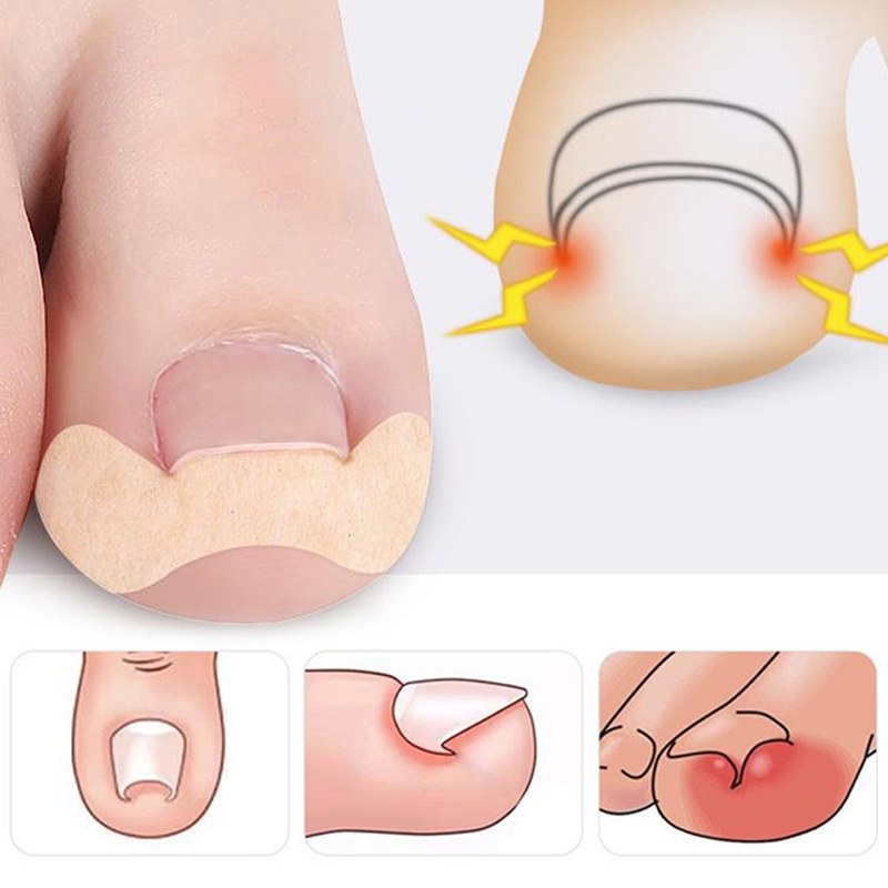 Glue-free nail sticker drop-down nail groove sticker toe nail tie meat band-aid embedded nail sticker nail meat separation sticker