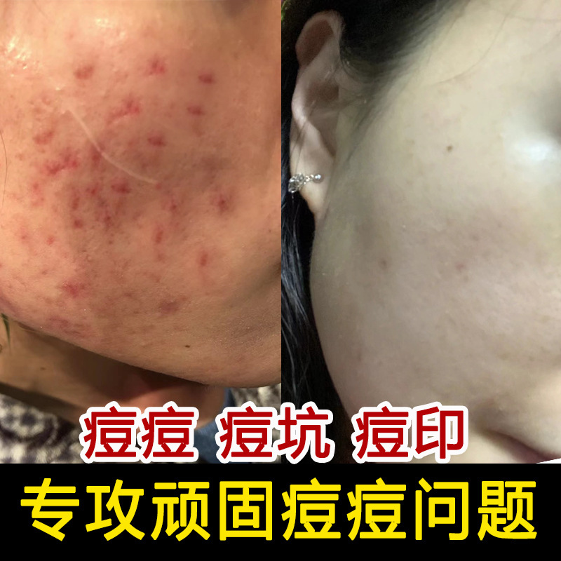 Acne Removal Essence for Closed Mouth Acne Acne Acne Fading Acne Print Repair Beauty Salon Salicylic Acid Acne Removal Water