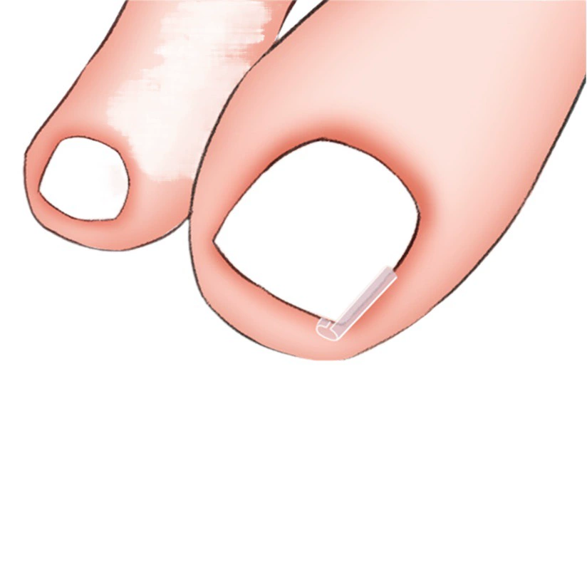 Инкрустация ногтей типа C