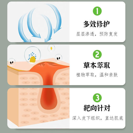 Youyoufuping health care cream Thorn chicken eye cream flat silk-shaped herbal mild non-irritating Keyou cream