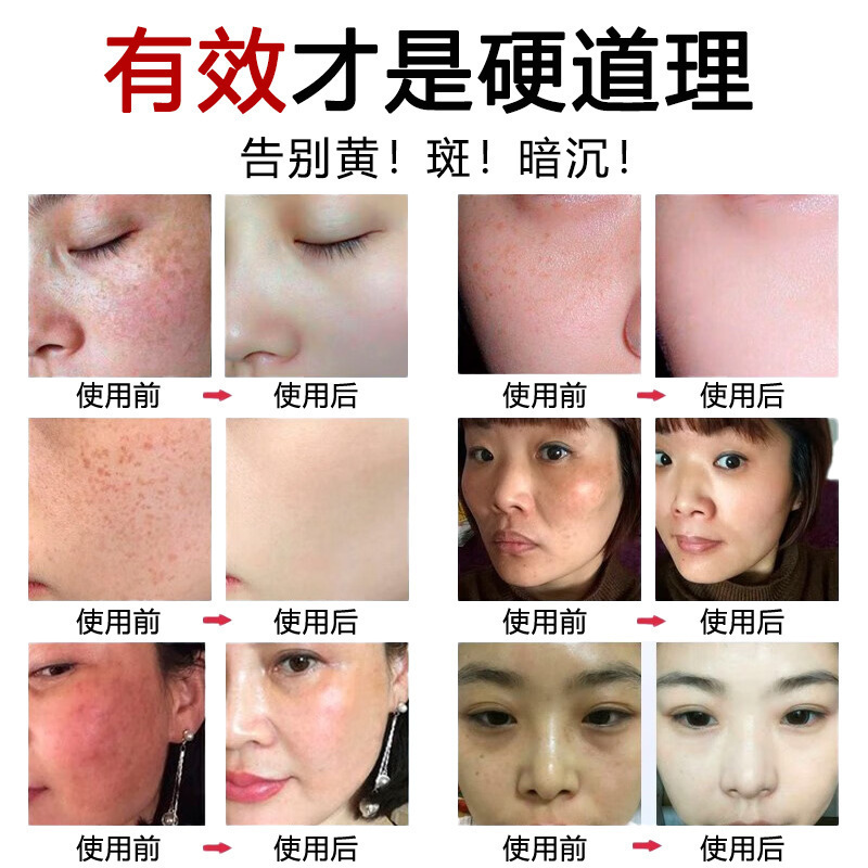美白・そばかす防止クリーム、強力そばかす・シミ・肝斑・日焼け・ニキビ跡・メラニン除去・エステサロン・フライドスポットクリーム|undefined