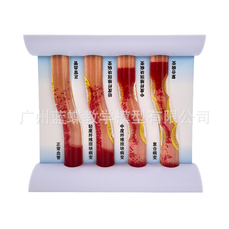 Ѫ�ܷ������Ѫ֬��Ѫ֬ģ�Ͳ�����̬Ӳ������Ѫ˨ֱ�۽�ѧ����