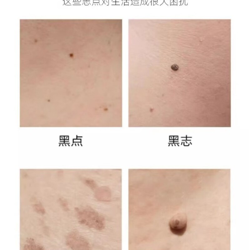 点痣膏全身可用去痣黑痣肉刺面部当场消痣无痕尤痦子瘊子脂肪粒美|undefined