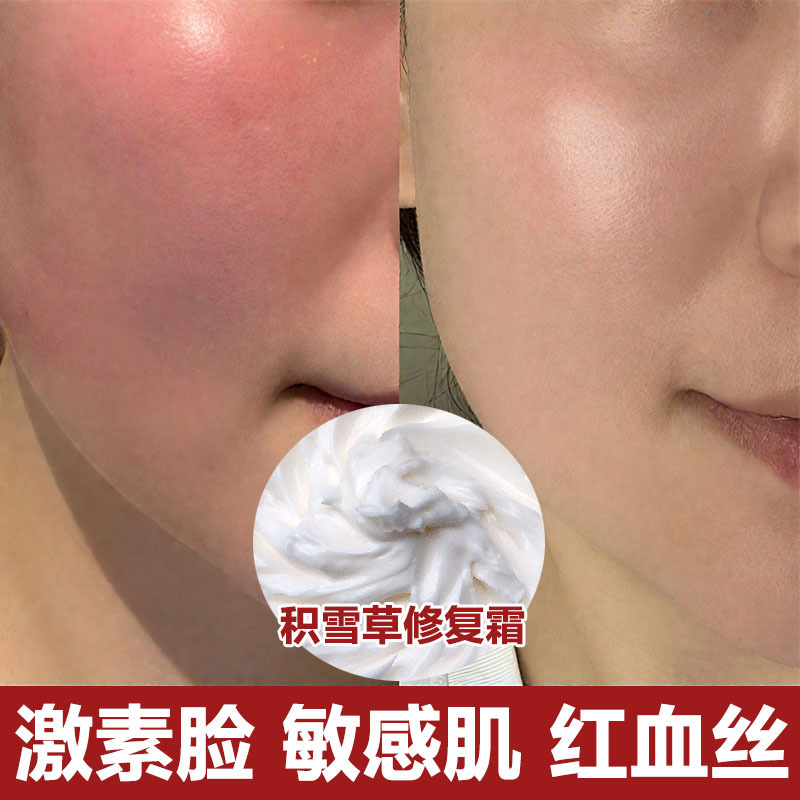 センテラ アジアティカ リペア クリーム 敏感肌を改善し、赤みを修復し、赤みを取り除き、ニキビ跡を除去します ビューティー サロン ライブ セル リペア クリーム|undefined