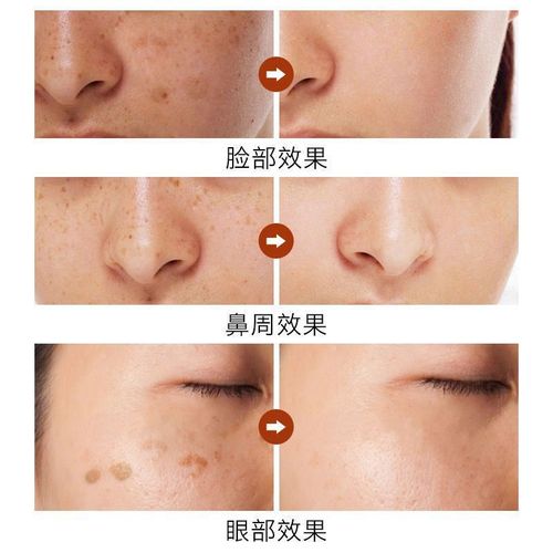 Arbutin cream fades spots, beauty salon brightens, removes dark yellow, improves chloasma, freckles, sun spots, color control cream