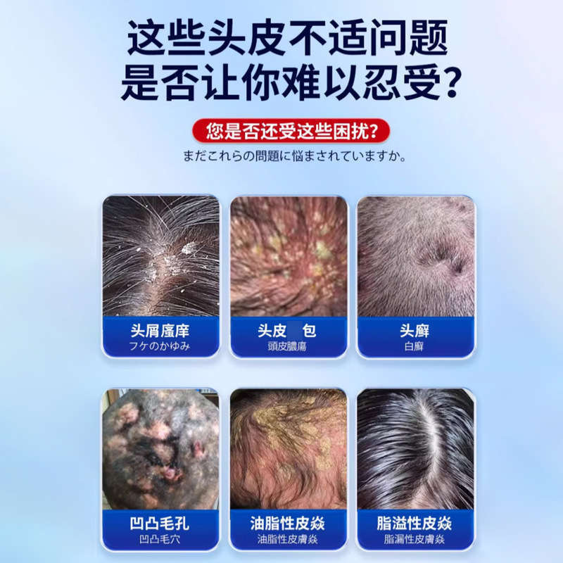 久研製薬頭部毛包治療炎シャンプー専用クリーム脂漏性治療皮膚炎頭皮屑工場直営|undefined