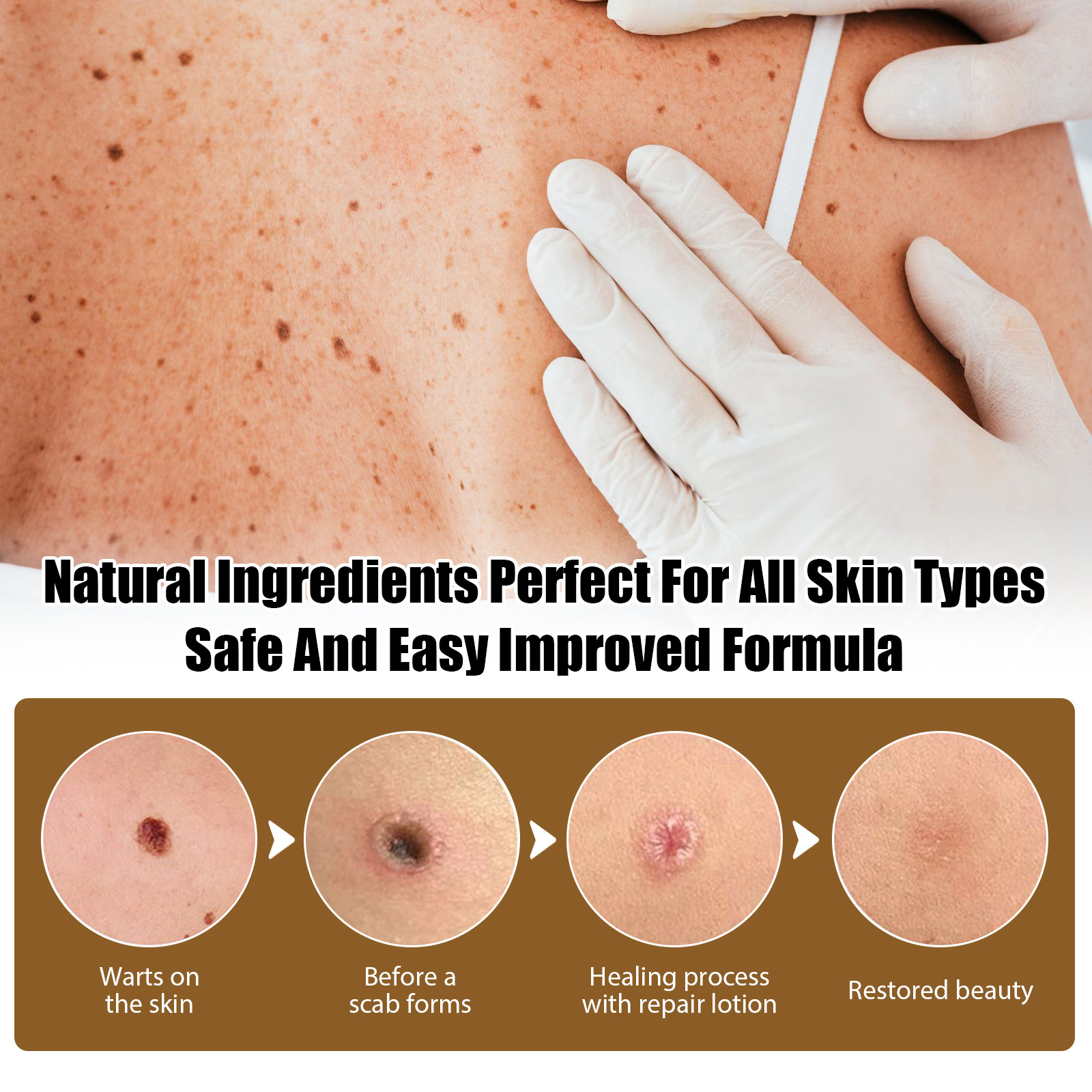 EELHOE wart oil repair for warts, black facial convex nevi, anti mole scar free nevus cocoon, clear and smooth skin_voghion.com