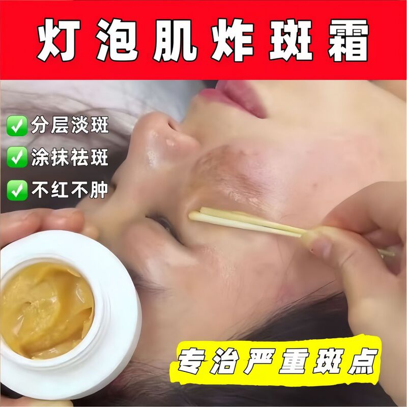 Special Bulb Muscle Spot Cream, No Redness, No Swelling, No Peeling, Mild Spot Removal, No Irritation, No Embarrassment, Spot Removal Cream