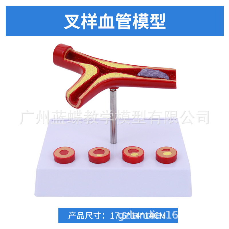 Ѫ�ܷ������Ѫ֬��Ѫ֬ģ�Ͳ�����̬Ӳ������Ѫ˨ֱ�۽�ѧ����