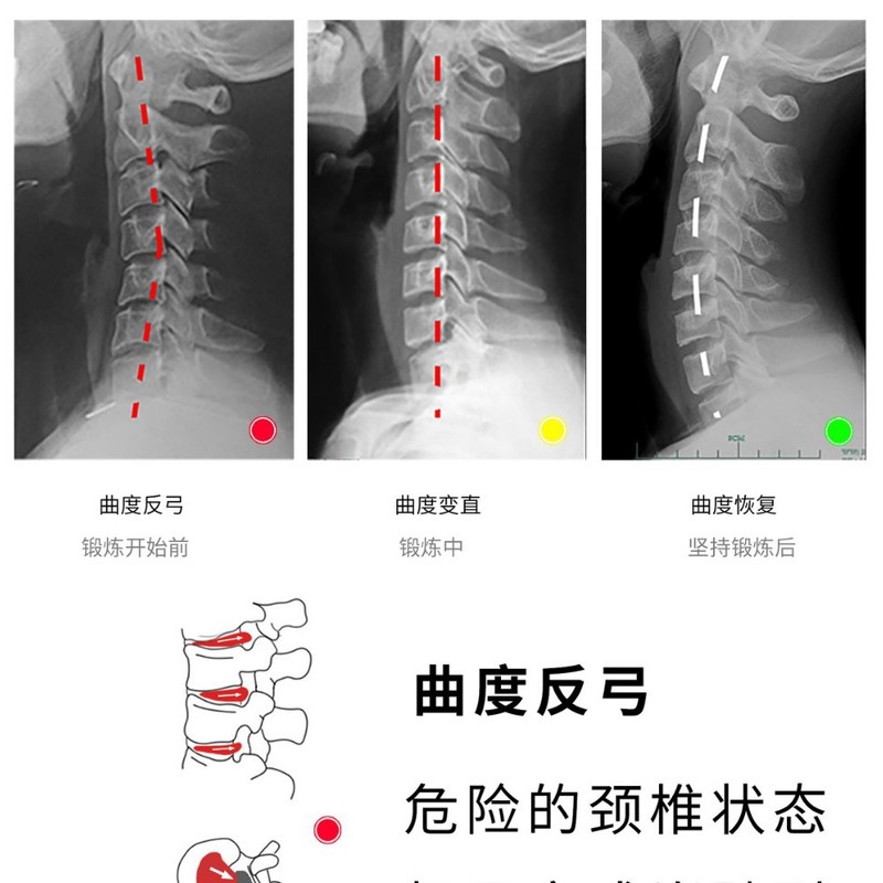 頚椎座屈筋頚部安定訓練器頚部延伸器頚椎筋対抗リハビリテーション|undefined