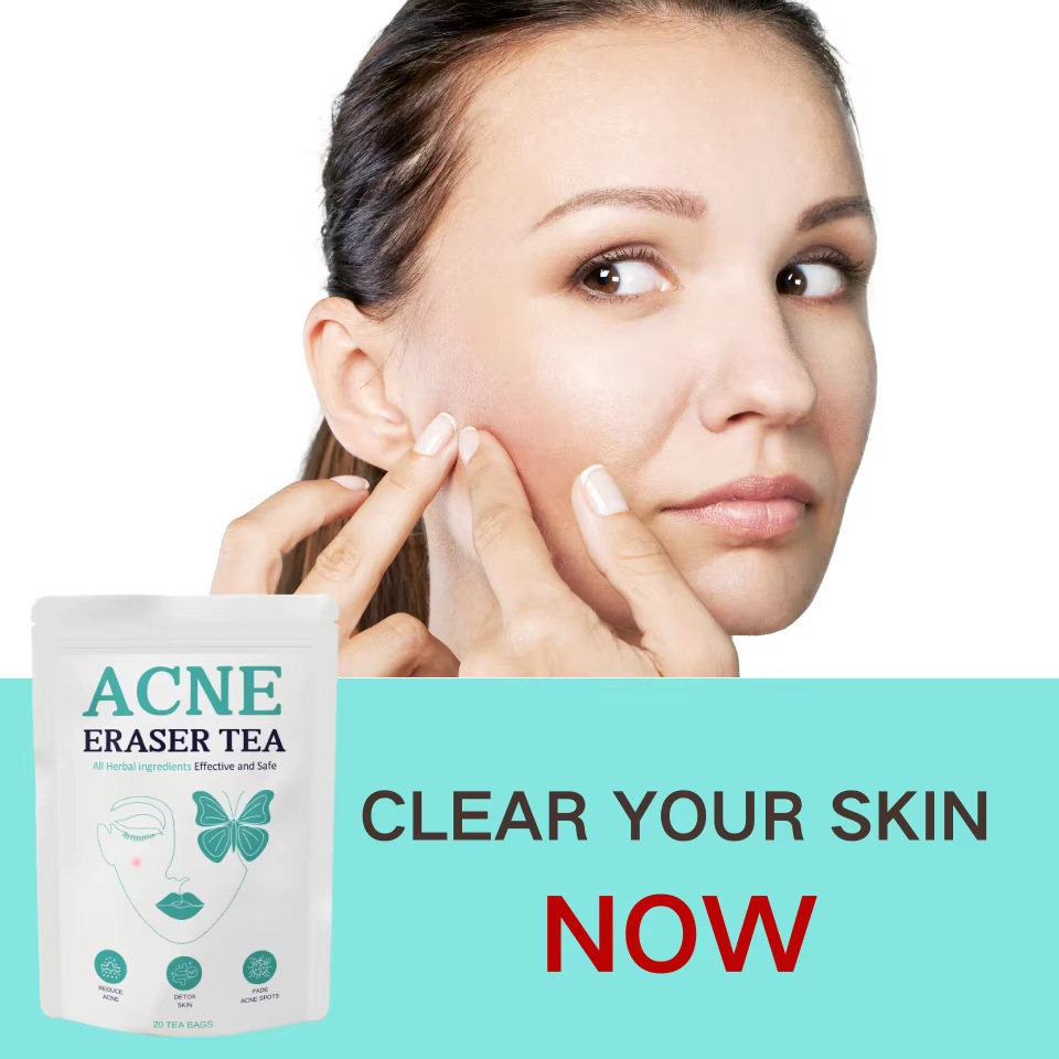 Acne Eraser Tea Herbal Wellness Tea 100g Cold Brew Sugar Free Sealed Pack quality and texture